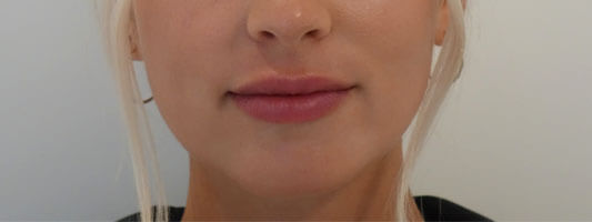 Patient-2-After