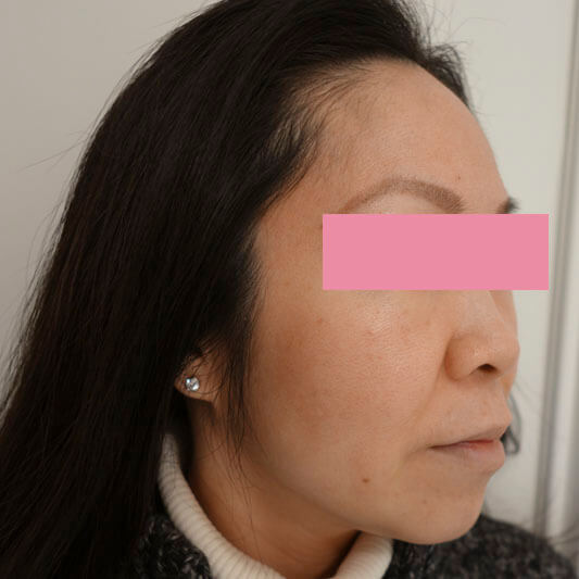 Patient-2-Micro-Needling-After