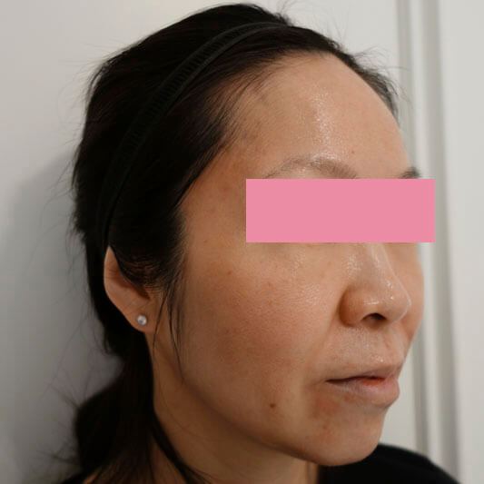 Patient-2-Micro-Needling-Before