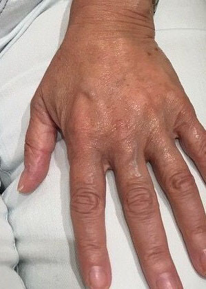 patient-4-after