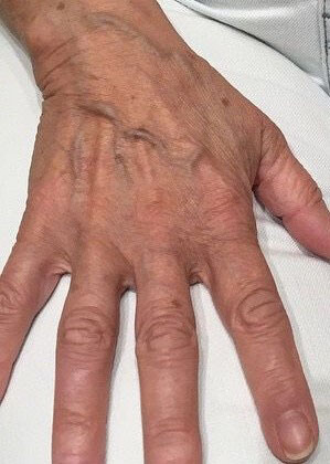patient-4_before